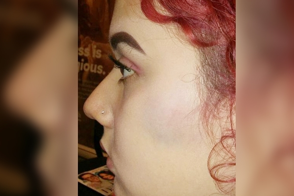 Transgender teen claims that she was punched multiple times in the face